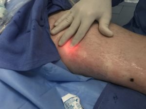 Procedurile cu laser in tratarea varicelor - cat de eficiente sunt?